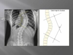 cobb angle