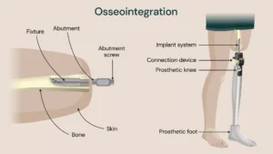 رحلة تركيب الأطراف الصناعية بالاندماج العظمي: التكاليف، المخاطر، وخطوات العودة للحياة الطبيعية تركيب طرف صناعي بالاندماج العظمي تركيب طرف صناعي بالاندماج العظمي