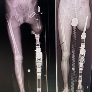 رحلة تركيب الأطراف الصناعية بالاندماج العظمي: التكاليف، المخاطر، وخطوات العودة للحياة الطبيعية تركيب طرف صناعي لبتر قصير تركيب طرف صناعي لبتر قصير